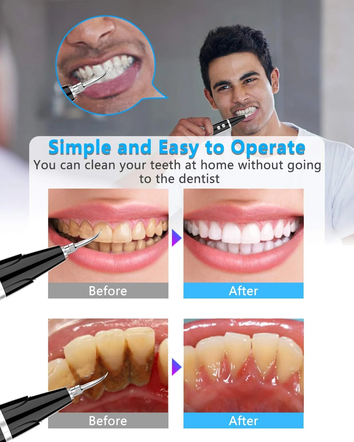 👨‍⚕🦷Electric tooth cleaning instrument -Teeth Cleaner