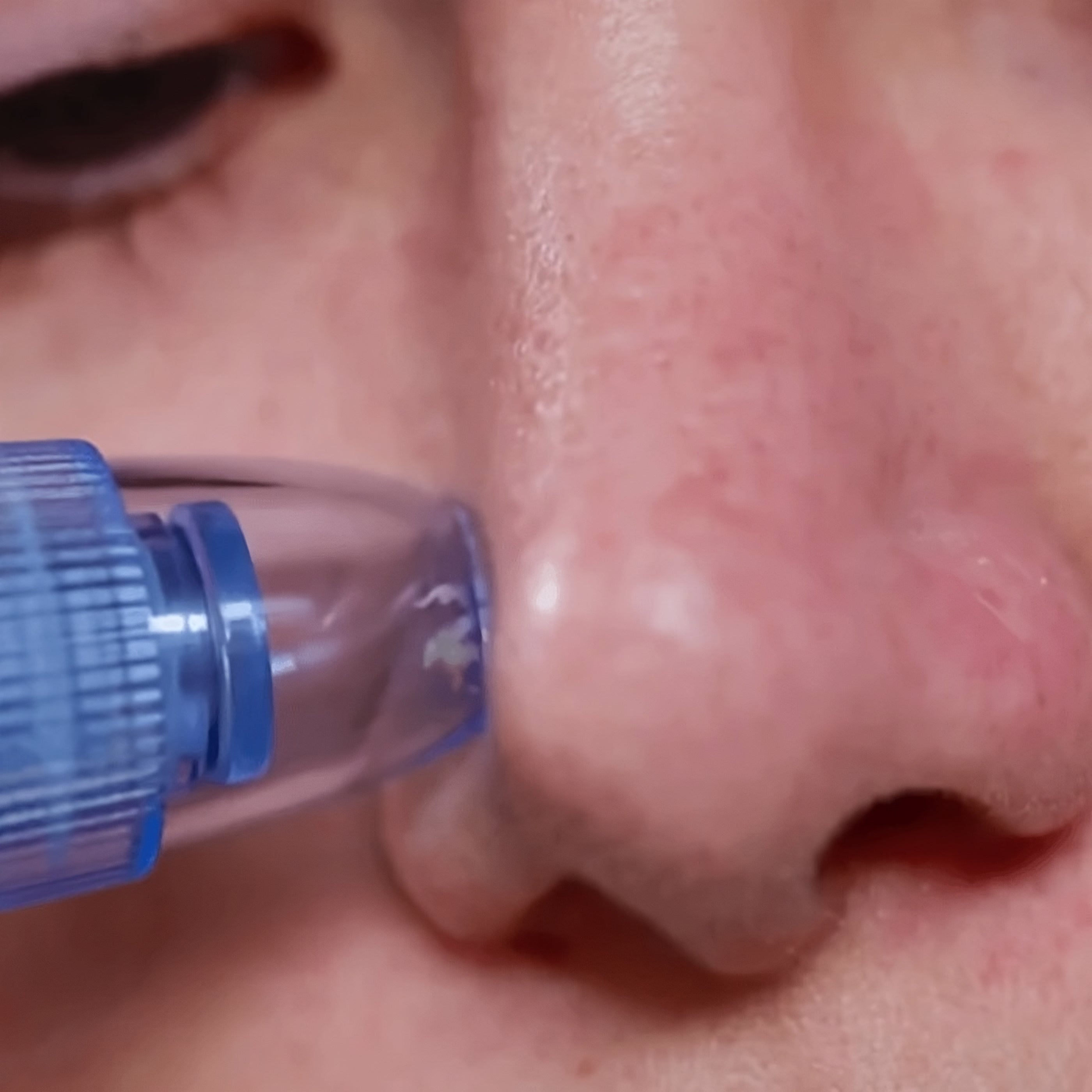 Blackhead Remover DermaSuction™